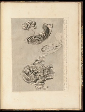 Anatomia uteri humani gravidi tabulis illustrata ... The anatomy of the human gravid uteris exhibited in figures / [William Hunter].