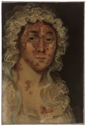 Mrs Bennett, afflicted with a skin disease. Oil painting, 1818/1821.