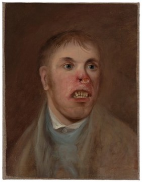 A young man, J. Kay, afflicted with a disease which has eaten away part of his face. Oil painting, ca. 1820.