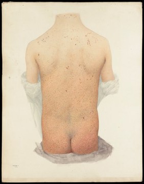 Back of a boy with skin disease. Watercolour by W. Toogood Hill, 1891.