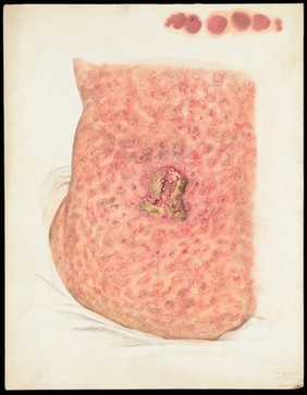 Back of a woman with disease and tumour. Watercolour by Mabel Green, 1894.