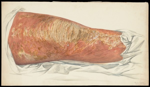 Popliteal area with disease. Watercolour by Mabel Green, 1900.