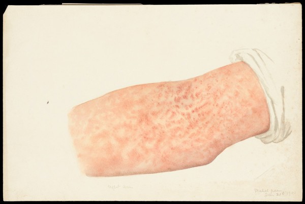 A right arm with skin disease designated as Lichen variegatus. Watercolour by Mabel Green, 1901.