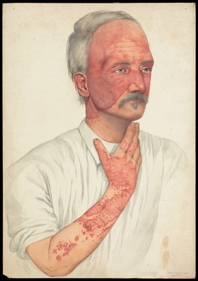 A man with disease designated as Lupus erythematosus. Watercolour by Mabel Green, 1902.