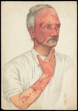 view A man with disease designated as Lupus erythematosus. Watercolour by Mabel Green, 1902.