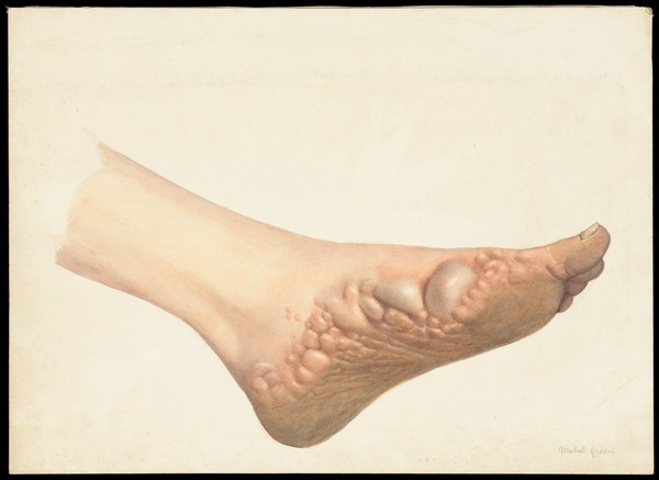 A foot with disease designated as pompholyx (also known as eczema). Watercolour by Mabel Green, 1906.