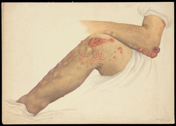 The left knee and elbow with skin disease. Watercolour by Mabel Green, 1906.