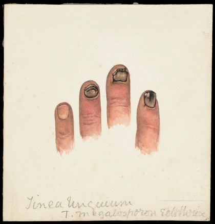 Four fingers with diseased nails designated as Tinea unguium. Watercolour, 1899.
