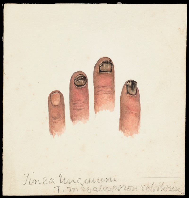 Four fingers with diseased nails designated as Tinea unguium