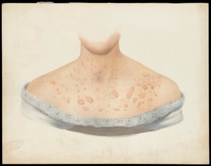 view The chest of a woman with skin disease designated as Pityriasis rosea. Watercolour, ca. 1900.
