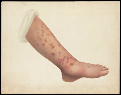 A diseased left leg and foot. Watercolour, ca. 1900.