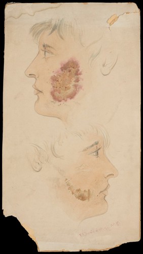 Face of a man with skin disease: two figures. Watercolour by R.W. Sherwin, ca. 1900.