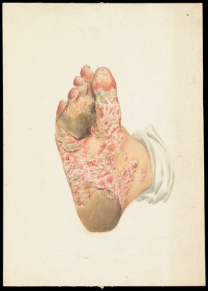 view Sole of the foot with florid skin disease. Watercolour, ca. 1900.