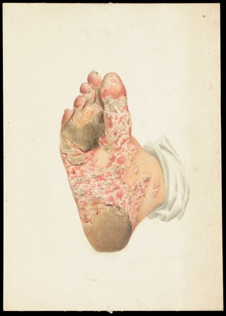 Sole of the foot with florid skin disease. Watercolour, ca. 1900.