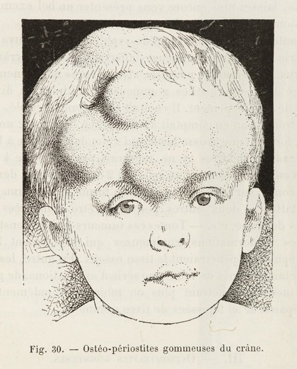 La syphilis héréditaire tardive : leçons professées / par Alfred Fournier.