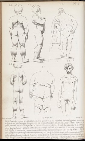 M0005170: Noel's apparatus for direct blood transfusion, 1876