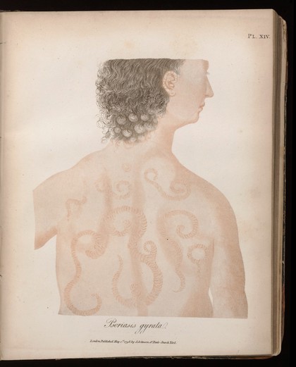 On cutaneous diseases ... / by Robert Willan.