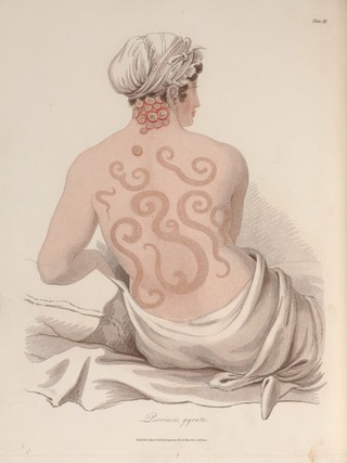 Delineations of cutaneous diseases: exhibiting the characteristic appearances of the principal genera and species comprised in the classification of Dr. Willan; and completing the series of engravings begun by that author / [Thomas Bateman].
