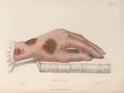 Delineations of cutaneous diseases: exhibiting the characteristic appearances of the principal genera and species comprised in the classification of Dr. Willan; and completing the series of engravings begun by that author / [Thomas Bateman].