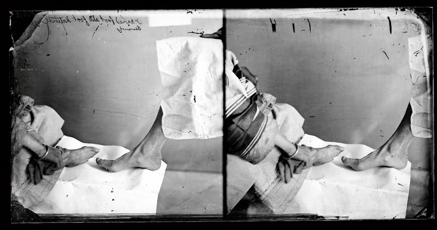 Amoy (Xiamen), Fukien province, China: bound and unbound feet of two Amoy women. Photograph by John Thomson, 1869.