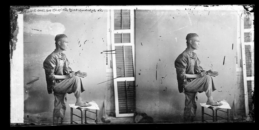 Amoy (Xiamen), Fukien province, China: a thief with his thumbs chopped off. Photograph by John Thomson, 1871.