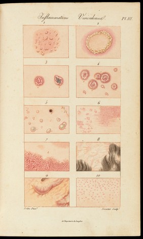 Traité théorique et pratique des maladies de la peau, fondé sur de nouvelles recherches d'anatomie et de physiologie pathologiques / Par P. Rayer.