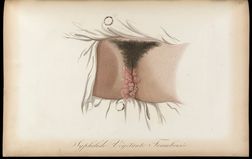 Description des maladies de la peau observées à l'Hôpital Saint-Louis. Et exposition des meilleures méthodes suivies pour leur traitement / par J.L. Alibert.