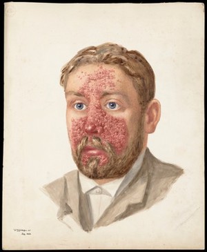 view The head of a man with skin disease. Watercolour by W. Toogood Hill, 1889.