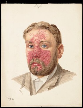 The head of a man with skin disease. Watercolour by W. Toogood Hill, 1889.