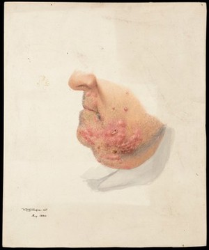 view The chin and lower left cheek of a man with skin disease. Watercolour by W. Toogood Hill, 1890.