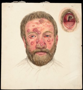 The head of a man with a beard and skin disease. Watercolour by Mabel Green, 1894.