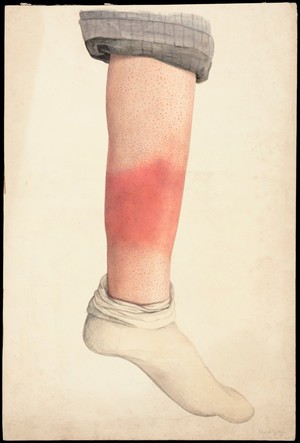 view The shin of a boy with a rash; rolled trouser-leg and sock in place. Watercolour by Mabel Green, 1896.