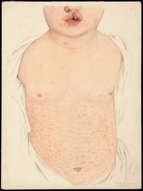 A boy with a congenital deformity of the mouth and a rash on the trunk. Watercolour by Mabel Green, 1901.