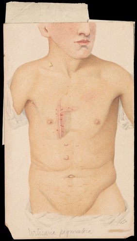 The trunk of a young man with a weal caused by urticaria. Watercolour by H.M.T. Hill, 1894.