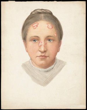 view The head of a young woman with loss of skin on her forehead and nose. Watercolour, ca. 1900.