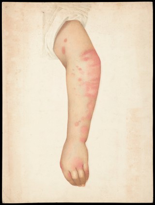 The arm of a woman with a rash. Watercolour, 1893.