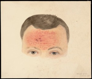 view The upper part of the head of a man with a rash on his forehead. Watercolour by Mabel Green, 1906.