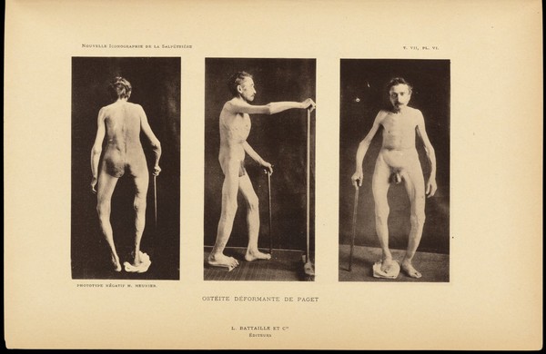 Male figure showing signs of Paget's disease