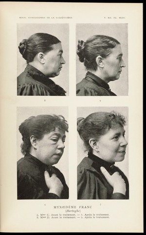 view Photographs showing females with myxedema