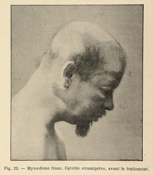 view Male figure with myxedema, after treatment. Caption: 'Myxoedeme franc. Calvitie strumiprive, avant le traitement'