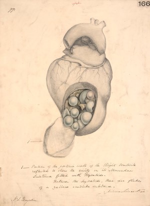 view Acephalocyst hyatids in the wall of the right ventricle of the heart