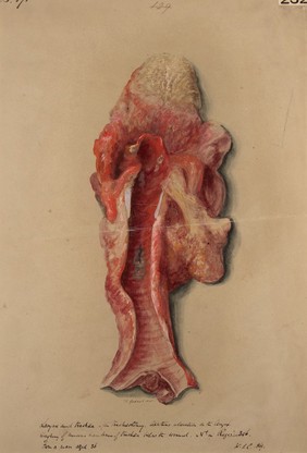 Larynx and trachea after tracheotomy, showing ulceration below the wound