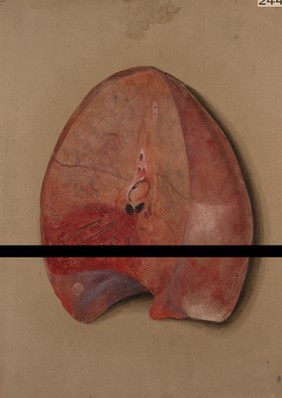 Lung showing effects of pleuro-pneumonia