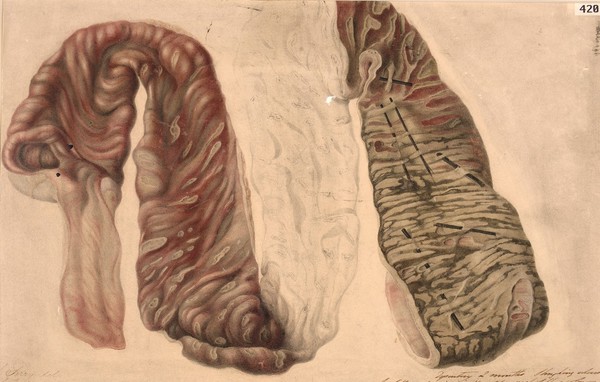 Dysentery, portion of colon showing sloughing ulcers