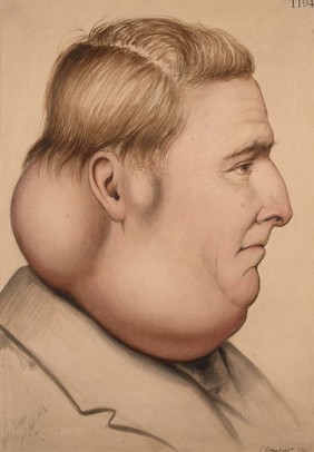 Man with diffuse lipoma of the neck