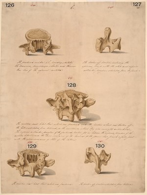 view Five drawings of fractured lumbar vertebrae