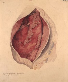 Empyema of the pleura