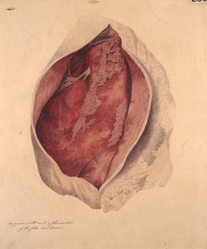 view Empyema of the pleura