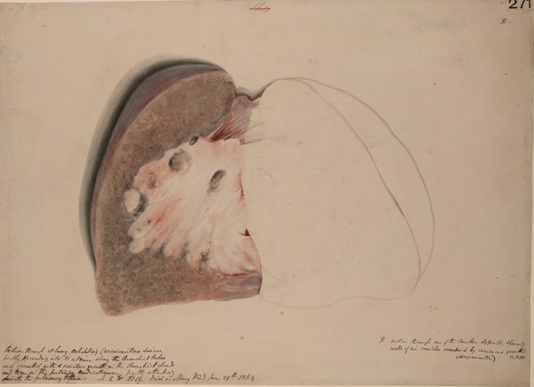 Section of lung exhibiting malignant disease, probably lympho-sarcoma