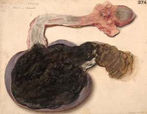 view Tongue, oesophagus and stomach from a case of oxalic acid poisoning